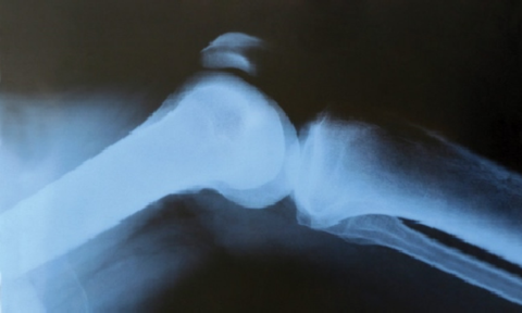 X-ray