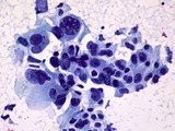 Non-small Cell Carcinoma of the Lung, FNA