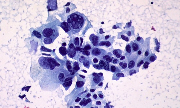 Non-small Cell Carcinoma of the Lung, FNA