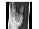 thumb arthritis xray